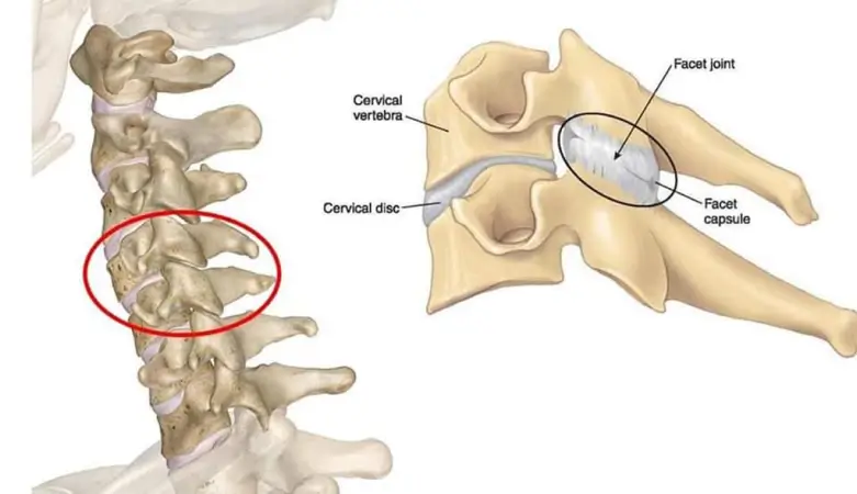 Cervical Disc